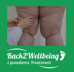 Lipoedema Treatment - Bournemouth, Dorset