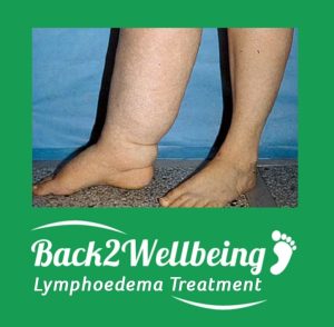 Lymphoedema Treatment - Bournemouth, Dorset